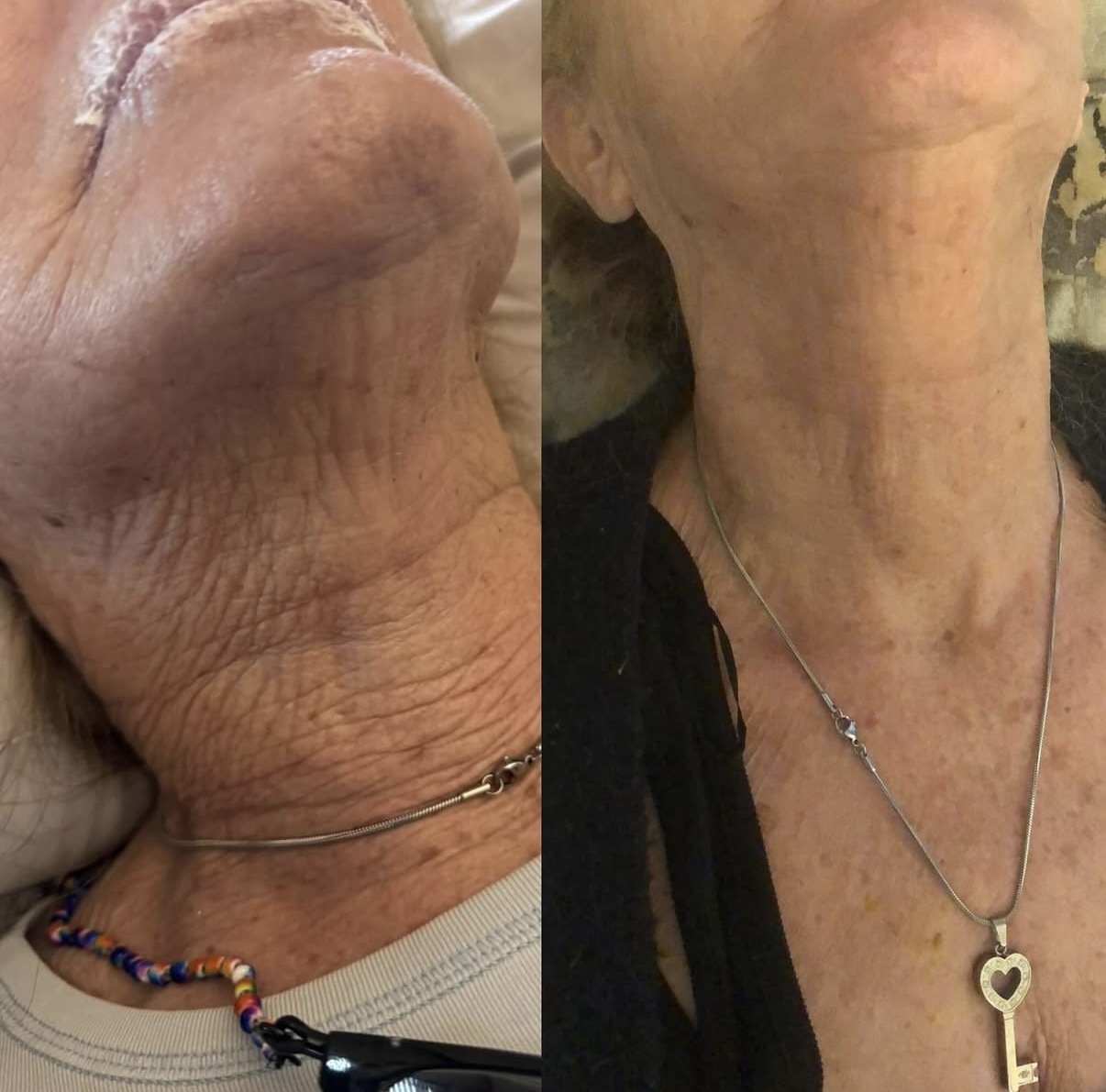 Skin rejuvenation result